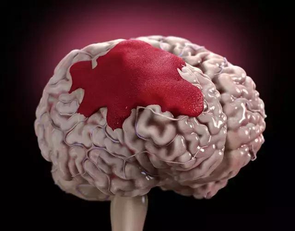 3D打印导板导航下的脑出血治疗新篇章