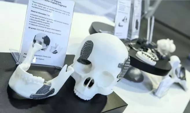 3D 打印医疗植入物：发现一些最具创新性的项目