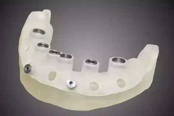 【3d打印种植牙】3D打印技术助力种植牙：现代口腔医学的突破与创新