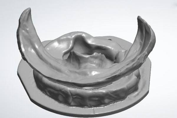 【3d打印 义齿】3D打印革新口腔健康：定制义齿的奇妙世界