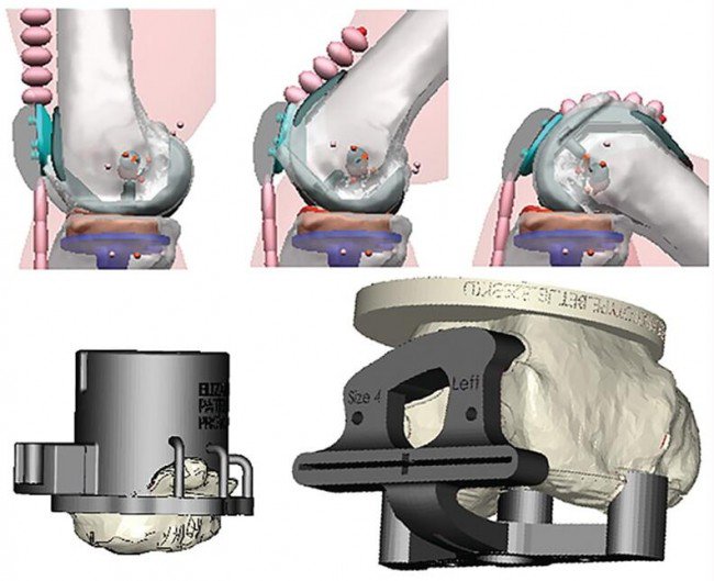 360 Knee Group 进行膝关节植入物虚拟测试