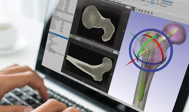 医学影像三维重建软件如何助力定制化3D打印植入物设计？
