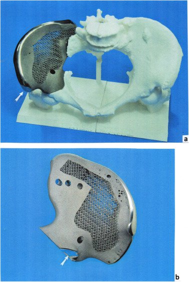  由EBM制造的Ti-6Al-4 V多孔网状骨盆带，是为患者特定的聚合物T-CAD模型定制