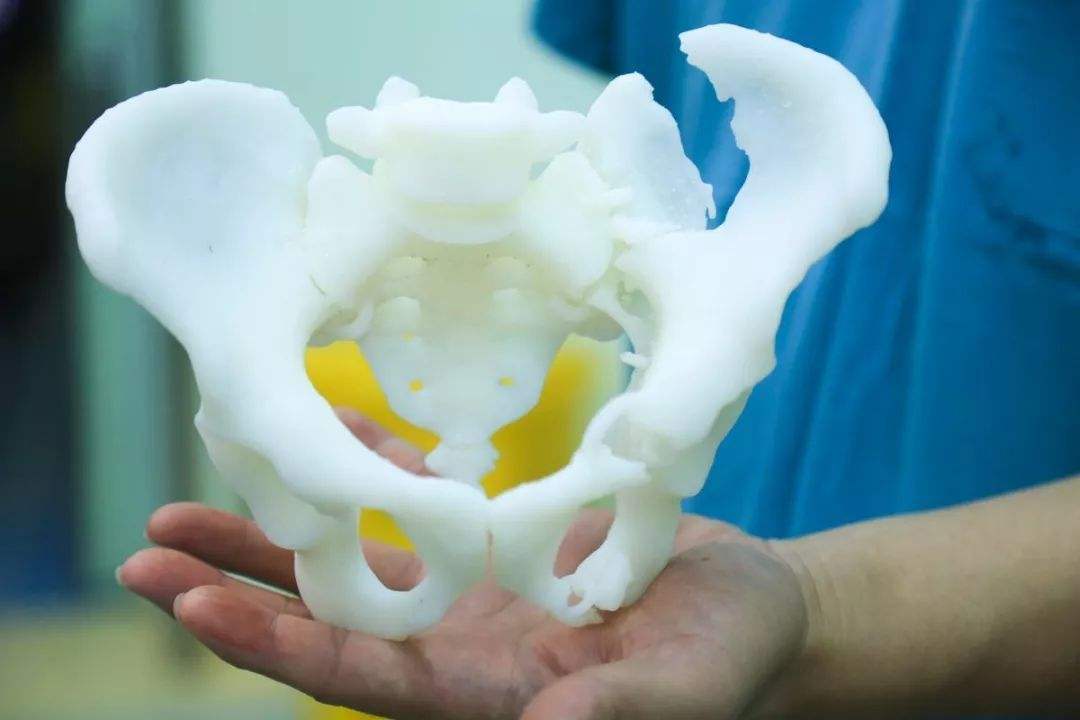 上海专家成功完成个性化3D打印骨盆重建手术
