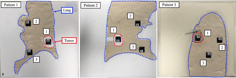 癌症患者福音！日本利用3D打印技术开发的新型系统可提高肿瘤治疗效果