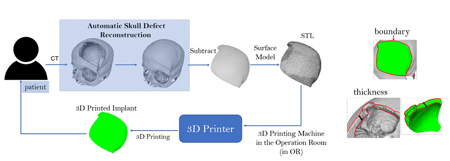 免费！免费！免费！可设计可3D打印颅骨植入物的软件问世