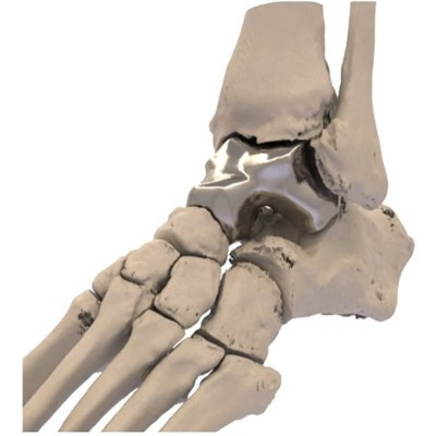 additiveorthopaedics的首个3d打印距骨植入物获fda批准