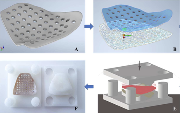 巴塞尔大学：独特的多孔3D打印植入物设计用于治疗眼窝骨折