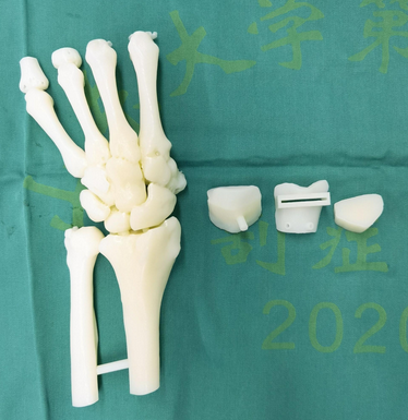 3D打印定制手术导板治愈十年前腕关节畸形!-aau3d打印