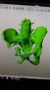 印度完成首例3D打印钛植入物手术