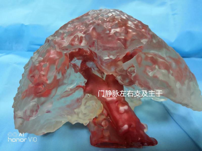 消化内科完成国内首例个体化3D打印精准辅助TIPS穿刺手术