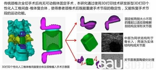 3D打印可动人工颈椎重建神经功能.jpg