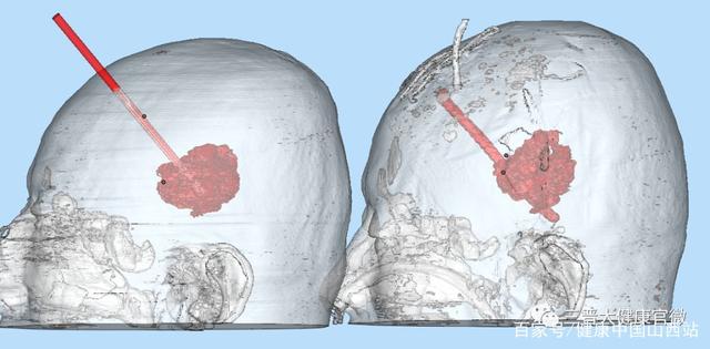山西大医院3D打印技术精准穿刺治疗脑出血
