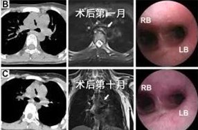 唐都医院3D打印可降解气管外支架成功救治气管软化症患儿