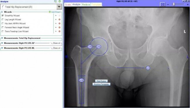 Materialise_smartHip