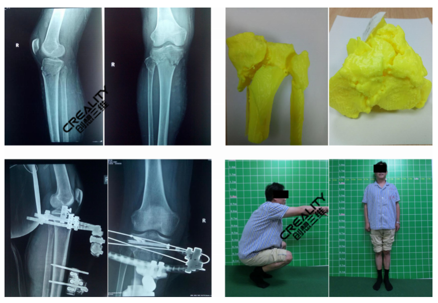 3D打印机对医学教育上运用的案例三