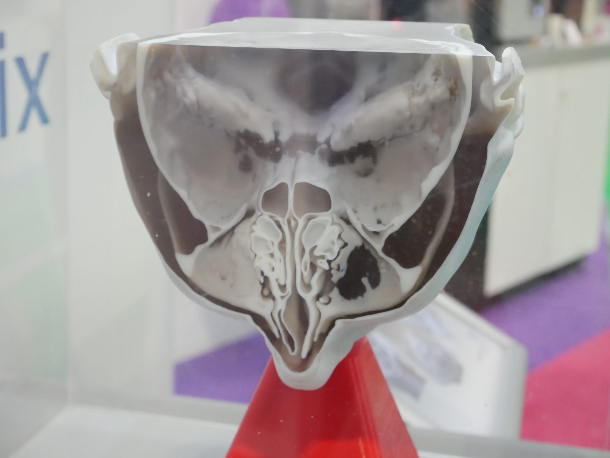 从MRI扫描在Stratasys J750上打印的3D医学3D模型