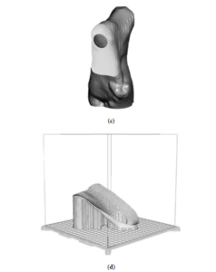 评估3D打印足矫形器对扁平足患者的重要性